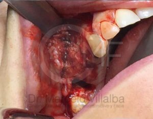 02_comunicacion-seno-maxilar2