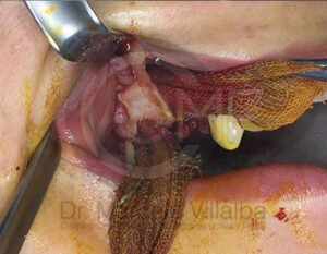 03_comunicacion-seno-maxilar-3