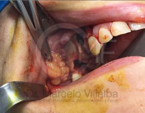 04_comunicacion-seno-maxilar4