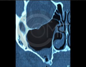 comunicacion-seno-maxilar12