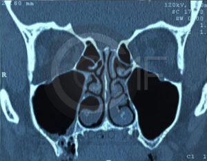 comunicacion-seno-maxilar14