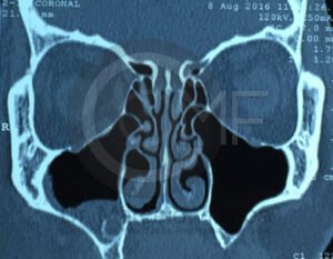 comunicacion-seno-maxilar16