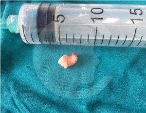 dientes-supernumerarios6-comf