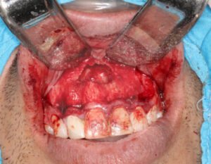 quistes-en-cavidad-oral01-comf