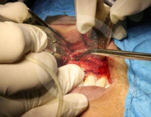 quistes-en-cavidad-oral04-comf