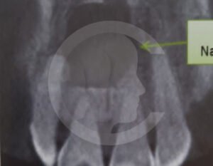 quistes-en-cavidad-oral06-comf