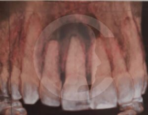 quistes-en-cavidad-oral07-comf