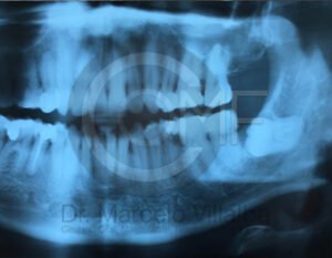terceros-molares7